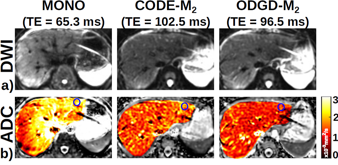 Diffusion MRI in the Body – Quantitative Imaging Methods Lab – UW–Madison